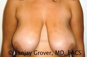Breast Reduction Before and After 08 | Sanjay Grover MD FACS