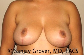 Breast Reduction Before and After | Grover Aesthetics