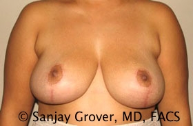 Breast Reduction Before and After | Sanjay Grover MD FACS