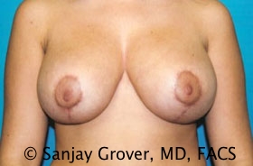 Breast Reduction Before and After | Grover Aesthetics