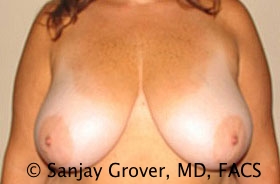 Breast Reduction Before and After 12 | Sanjay Grover MD FACS