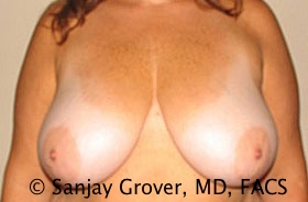 Breast Reduction Before and After 05 | Sanjay Grover MD FACS