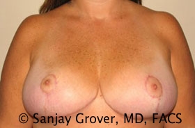 Breast Reduction Before and After | Grover Aesthetics