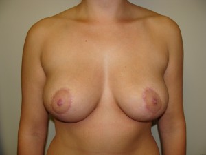 Breast Reduction Before and After | Sanjay Grover MD FACS