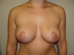 Breast Reduction Before and After | Grover Aesthetics