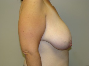 Breast Reduction Before and After 19 | Sanjay Grover MD FACS