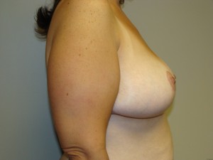 Breast Reduction Before and After 19 | Grover Aesthetics