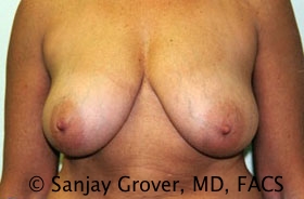 Breast Reduction Before and After | Grover Aesthetics