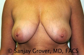 Breast Reduction Before and After 06 | Sanjay Grover MD FACS