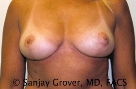 Breast Reduction Before and After | Grover Aesthetics