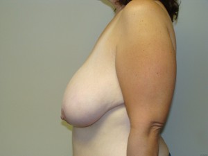 Breast Reduction Before and After 20 | Grover Aesthetics