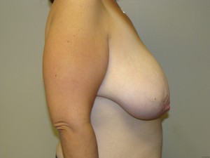 Breast Reduction Before and After 20 | Grover Aesthetics