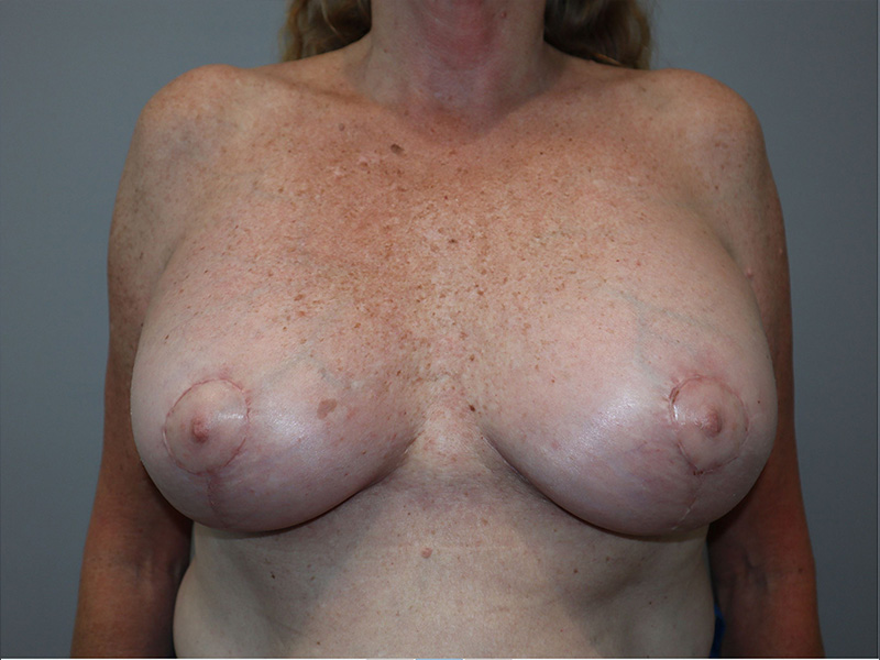 Breast Revision Before and After | Grover Aesthetics