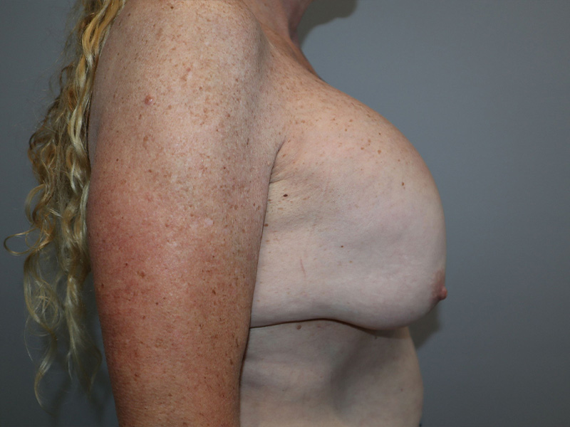 Breast Revision Before and After 01 | Grover Aesthetics
