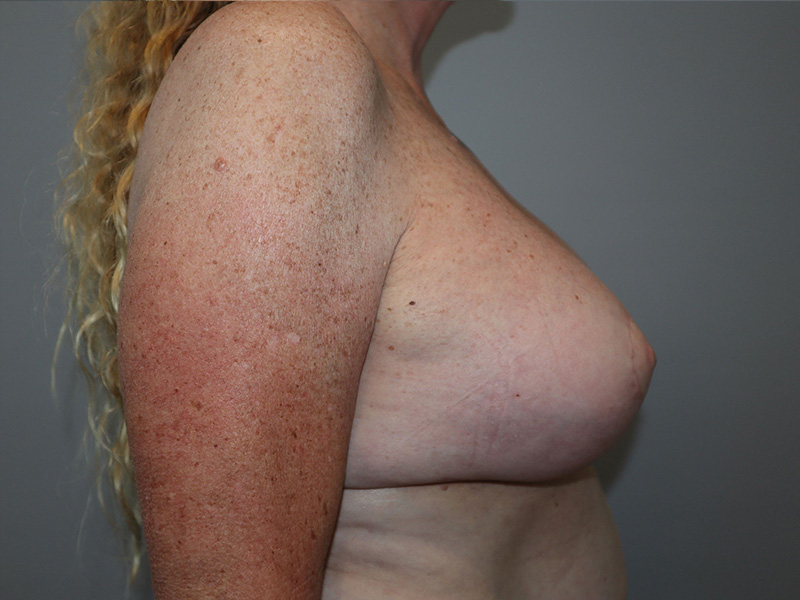 Breast Revision Before and After 01 | Grover Aesthetics