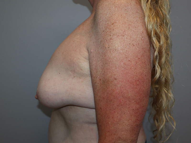 Breast Revision Before and After 01 | Grover Aesthetics