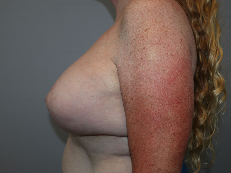 Breast Revision Before and After 01 | Grover Aesthetics