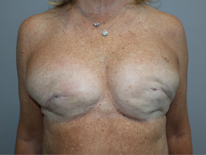 Breast Revision Before and After | Grover Aesthetics