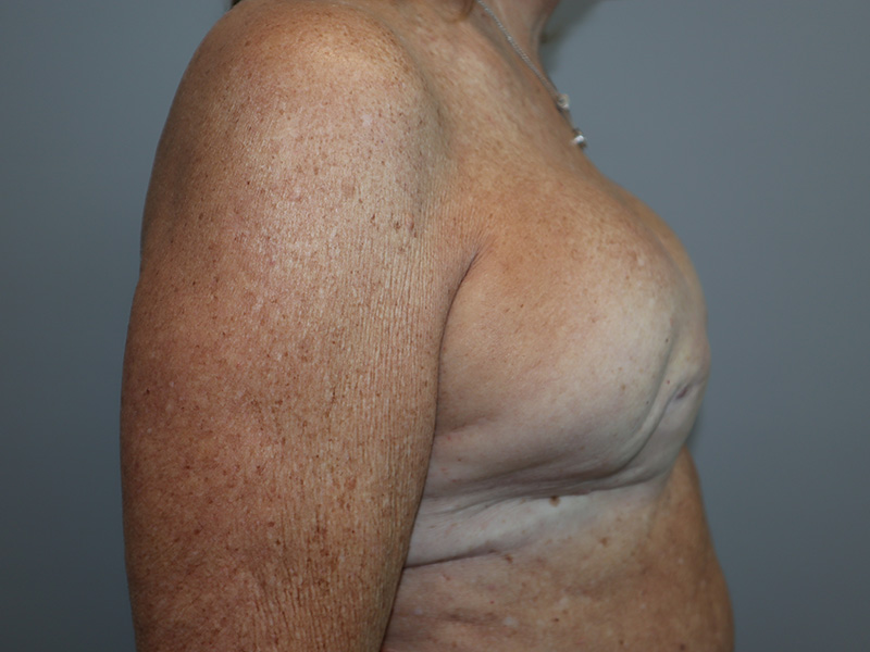 Breast Revision Before and After 02 | Grover Aesthetics