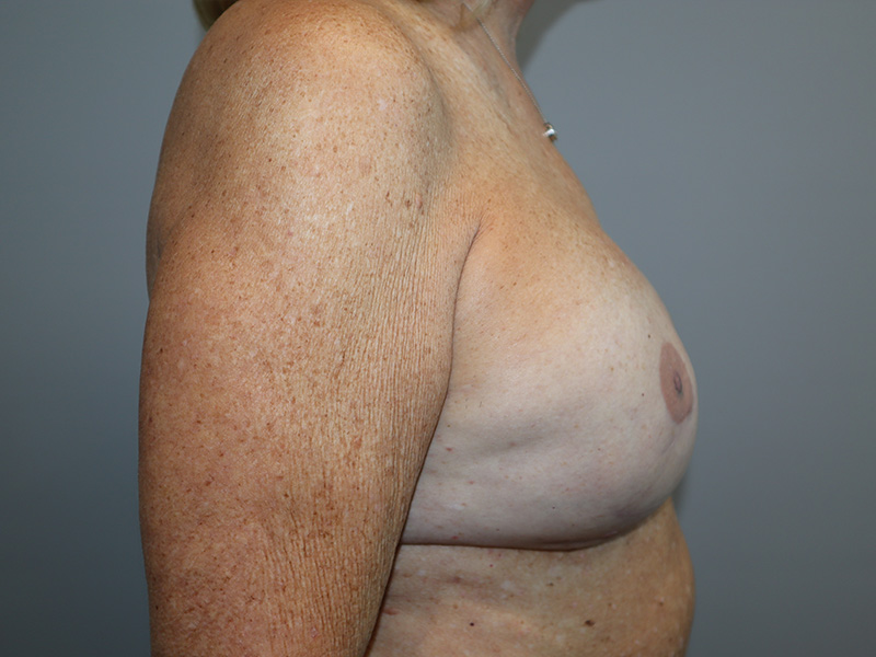 Breast Revision Before and After 02 | Grover Aesthetics