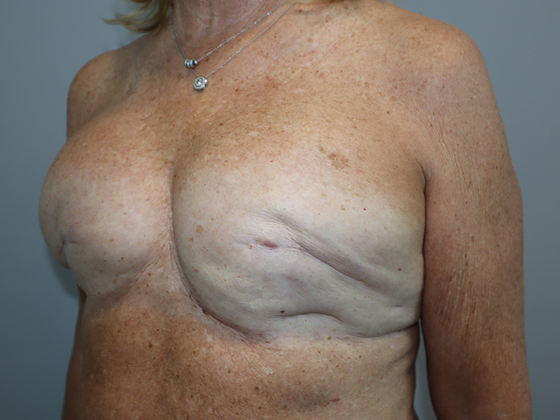 Breast Revision Before and After 02 | Grover Aesthetics