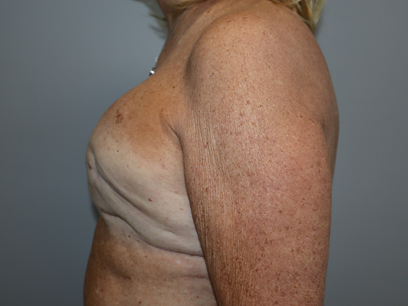 Breast Revision Before and After 02 | Grover Aesthetics