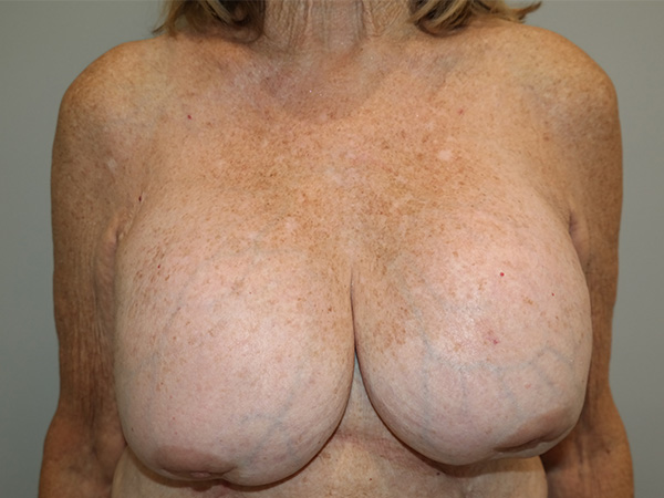 Breast Revision Before and After 10 | Sanjay Grover MD FACS