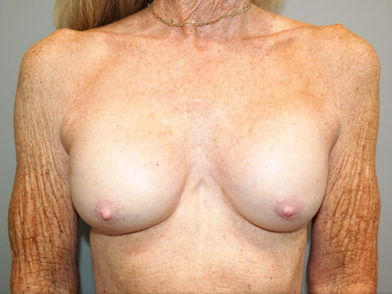 Breast Revision Before and After | Grover Aesthetics