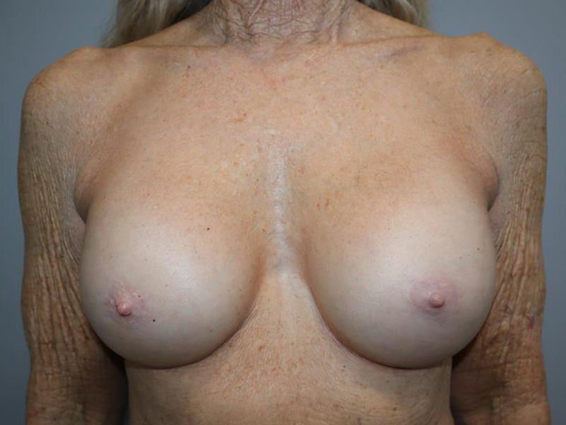 Breast Revision Before and After | Grover Aesthetics