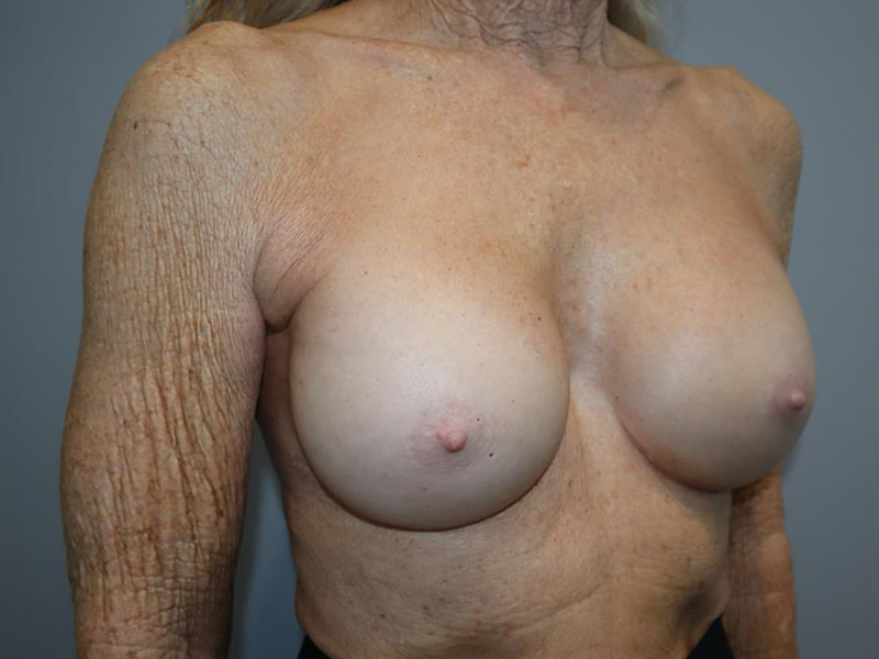 Breast Revision Before and After 03 | Grover Aesthetics