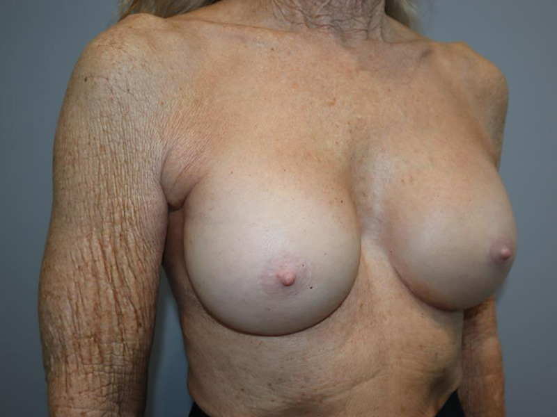 Breast Revision Before and After 03 | Sanjay Grover MD FACS