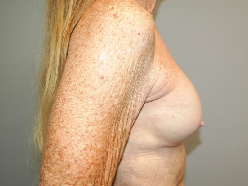 Breast Revision Before and After 03 | Grover Aesthetics