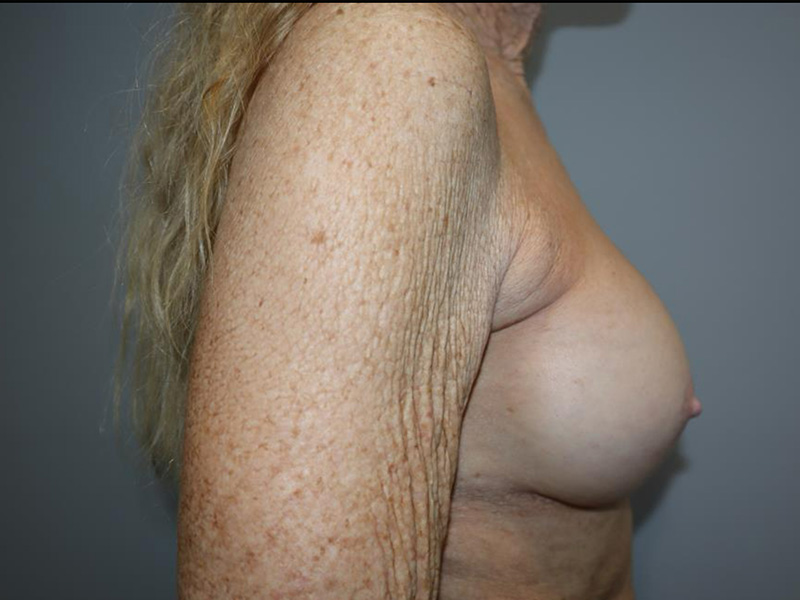 Breast Revision Before and After 03 | Grover Aesthetics