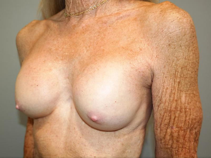 Breast Revision Before and After 03 | Sanjay Grover MD FACS