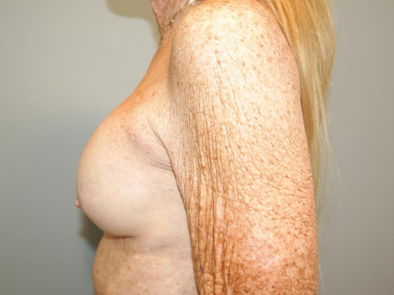 Breast Revision Before and After 03 | Grover Aesthetics