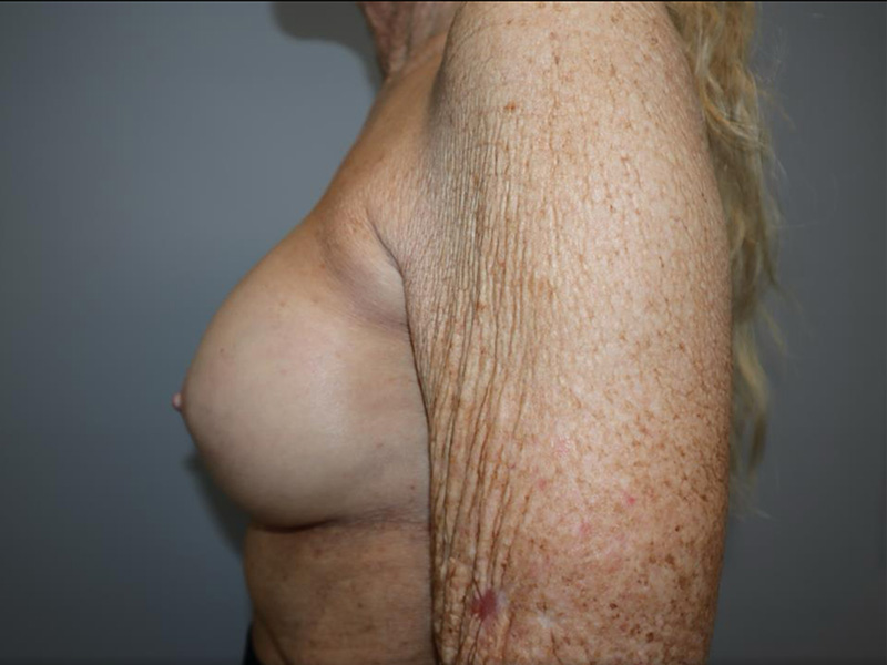 Breast Revision Before and After 03 | Grover Aesthetics