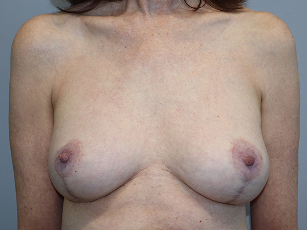 Breast Revision Before and After | Grover Aesthetics