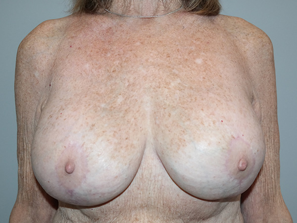 Breast Revision Before and After | Grover Aesthetics