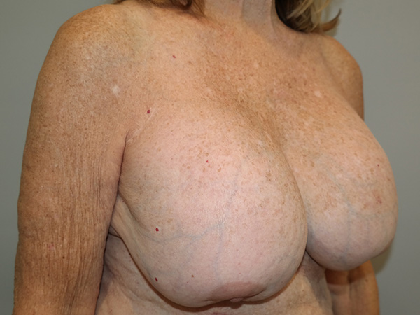 Breast Revision Before and After 09 | Grover Aesthetics