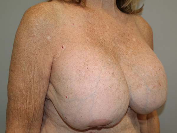 Breast Revision Before and After 09 | Sanjay Grover MD FACS