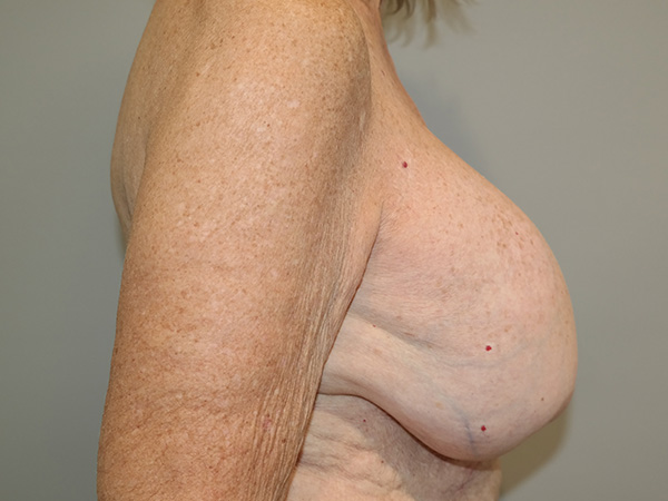 Breast Revision Before and After 09 | Sanjay Grover MD FACS