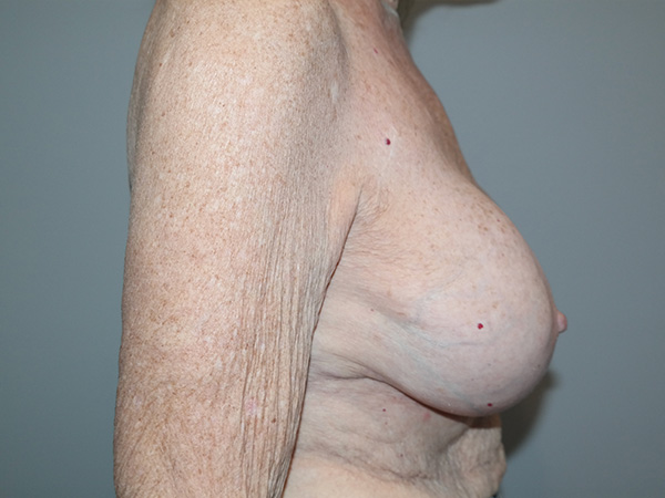 Breast Revision Before and After 09 | Grover Aesthetics