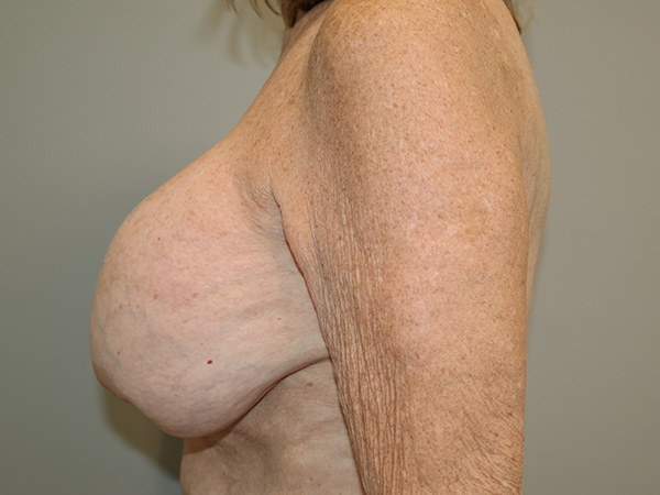 Breast Revision Before and After 09 | Grover Aesthetics