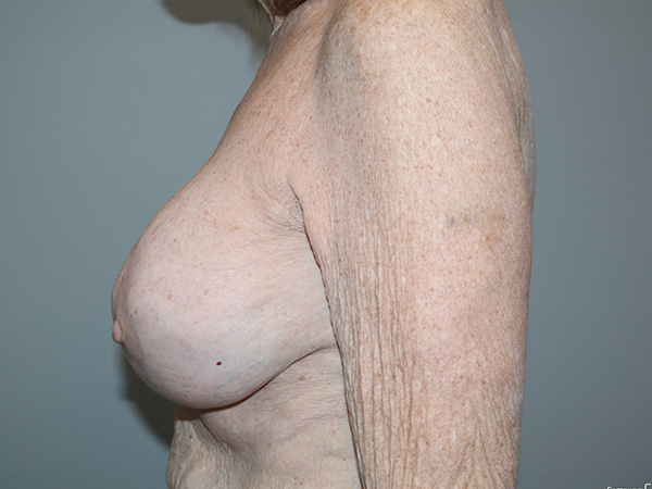 Breast Revision Before and After 09 | Grover Aesthetics
