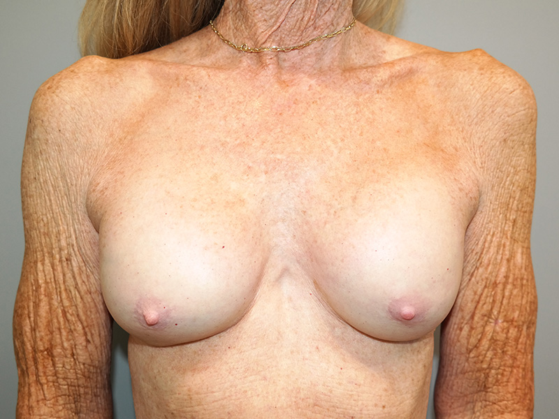 Breast Revision Before and After | Grover Aesthetics