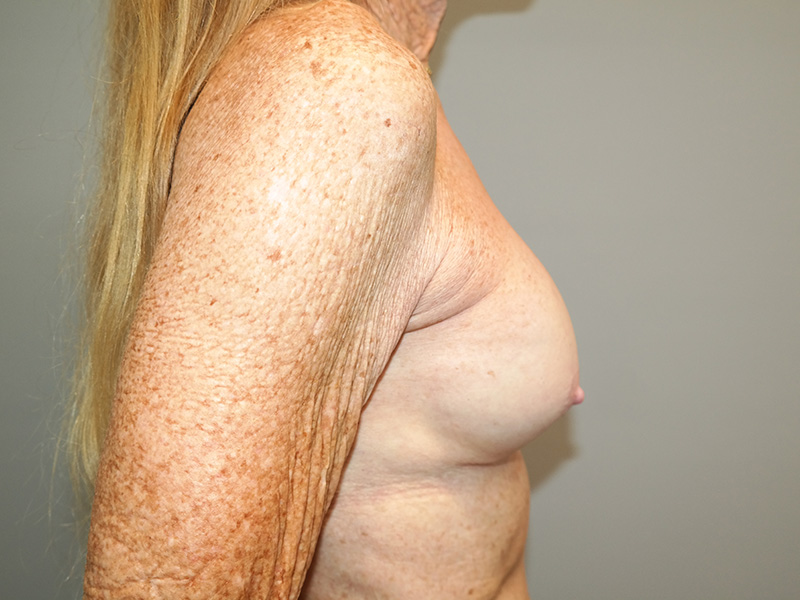 Breast Revision Before and After 11 | Grover Aesthetics