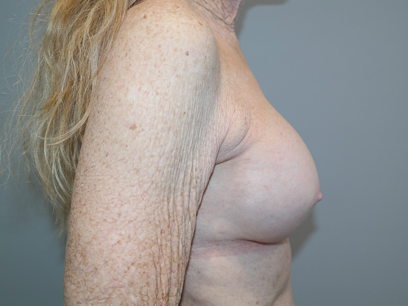 Breast Revision Before and After 11 | Grover Aesthetics