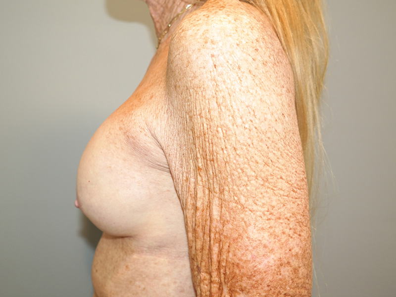 Breast Revision Before and After 11 | Grover Aesthetics