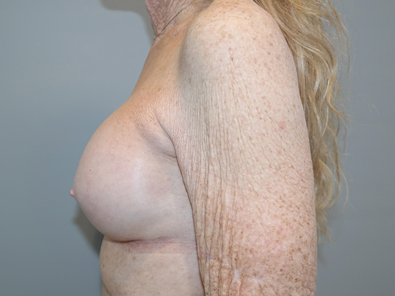 Breast Revision Before and After 11 | Grover Aesthetics