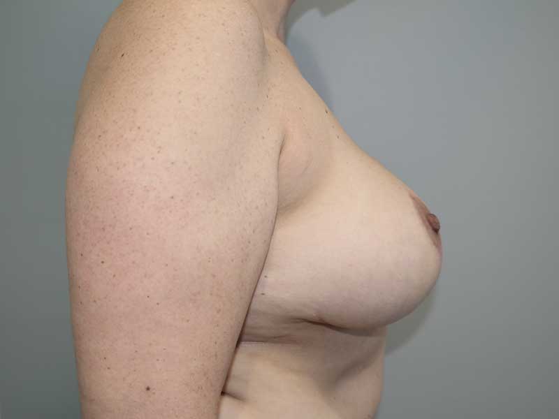 Breast Revision Before and After 16 | Grover Aesthetics